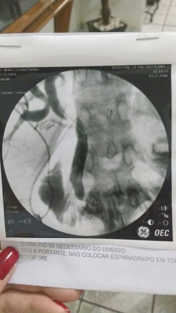 Controle de Rx na cirurgia por videolaparoscopia mostrando canal biliar sem cálculo